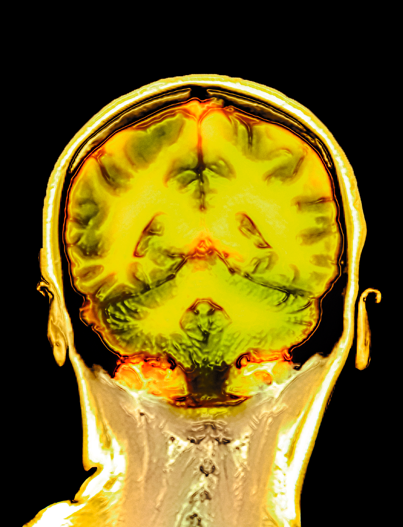 Resonancia magnética a color del cerebro sano de una mujer de 32 años